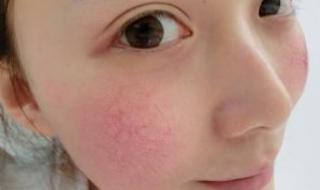 有红血丝怎么办 有红血丝怎么办