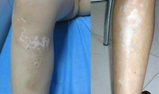 白癜风早期症状图片 白癜风早期症状图片